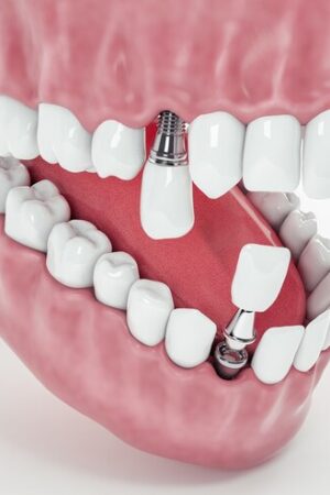 Pourquoi le prix implant dentaire varie-t-il autant et comment faire le bon choix ?