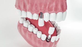 Pourquoi le prix implant dentaire varie-t-il autant et comment faire le bon choix ?