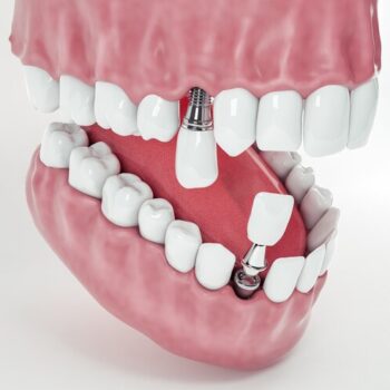 Pourquoi le prix implant dentaire varie-t-il autant et comment faire le bon choix ?