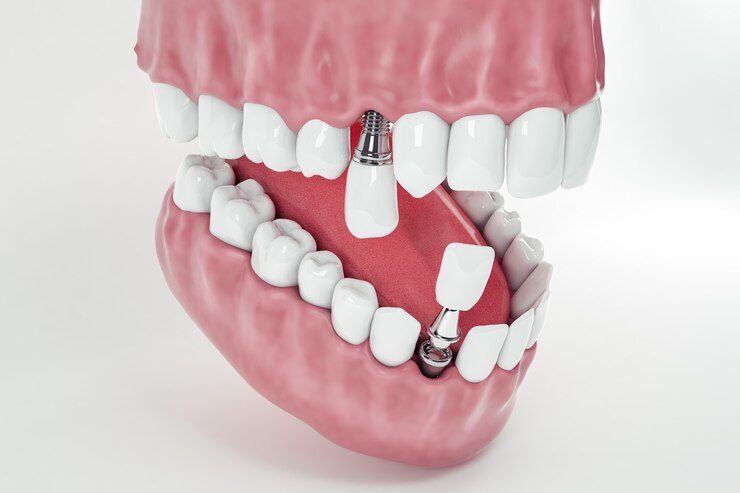 Pourquoi le prix implant dentaire varie-t-il autant et comment faire le bon choix ?